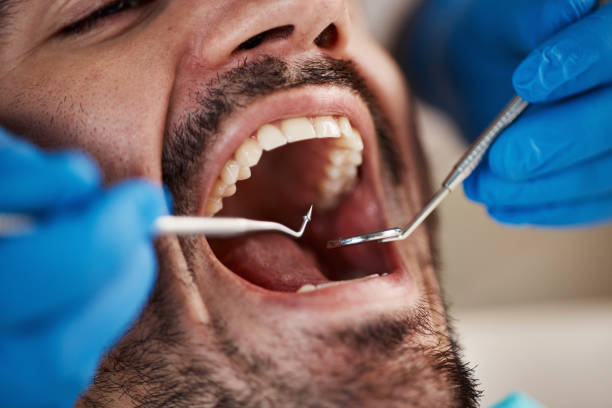 Best Emergency Tooth Extraction in Crestwood, KY